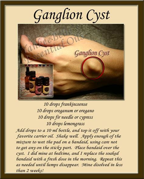 Remove Ganglion Cyst With A Book Margaret Greene Kapsels