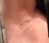 Photos of Armpit Pimple Treatment