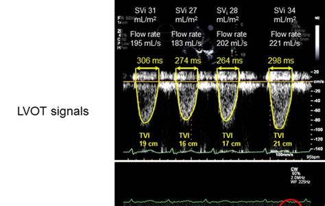 Aortic Stenosis Severity Underestimated When Mean Gradient Is Obtained