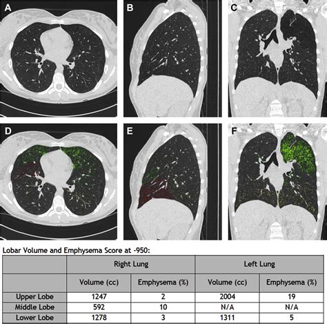 Diagnostic Value Of Quantitative Chest Ct Scan In A Case Of Spontaneous