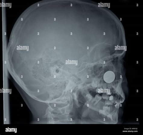 Lateral X Ray Of Pediatric Skull With Coin In Childs Nose Stock Photo