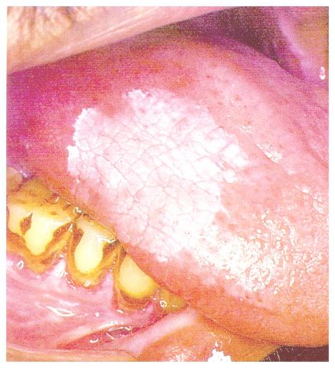 The patches are a hyperplasia of the. Leukoplakia