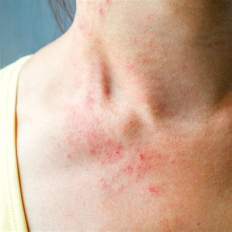 10 Common Reasons Behind That Itchy Skin Rash Scoopwhoop