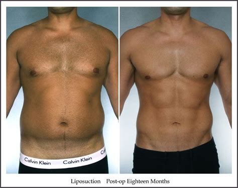 New York Male Liposuction Before And After Photo Gallery By Dr John E Sherman Plastic Surgeon