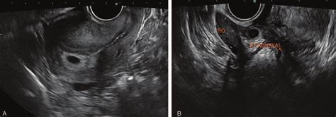 A Sonographic Feature Of Normal Intrauterine Pregnancy Of Heterotopic
