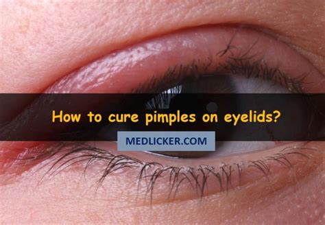 'how to cure pimples' guide is based on latest medical studies and researches in skin health and acne treatment methods. PIMPLES ON EYELIDS: causes, symptoms, treatment and prevention