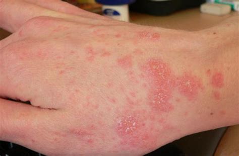 Scabies Rash On Face