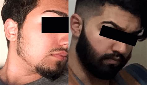 Top 10 Minoxidil Before And After Beard Growth Transformation Beardsome