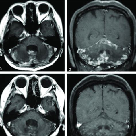 Magnetic Resonance Imaging Images Ab T1 Weighted Gadolinium Enhanced