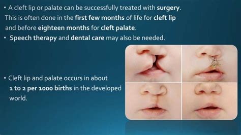 Principles Of Cleft Lip And Palate Formation