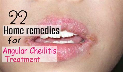 22 Effective Home Remedies For Angular Cheilitis Treatment 22