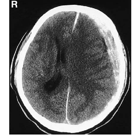 Computed Tomography Scan Showing A Left Acute Subdural Hematoma With Download Scientific