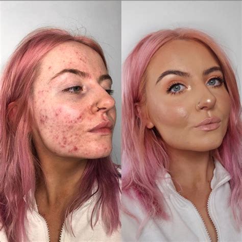 Acne Before And After Makeup Before And After