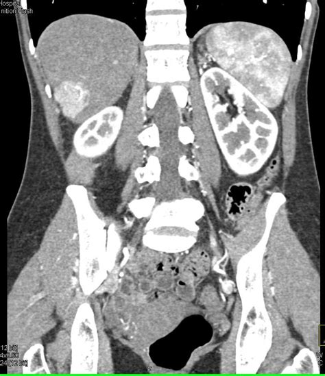 Focal Nodular Hyperplasia Fnh Liver Liver Case Studies Ctisus Ct