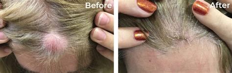 What Are Scalp Cysts Scalp Cyst Treatment Altruderm