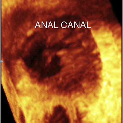 Three Dimensional Endoanal Ultrasound With Multiplanar Image Analysis Download Scientific