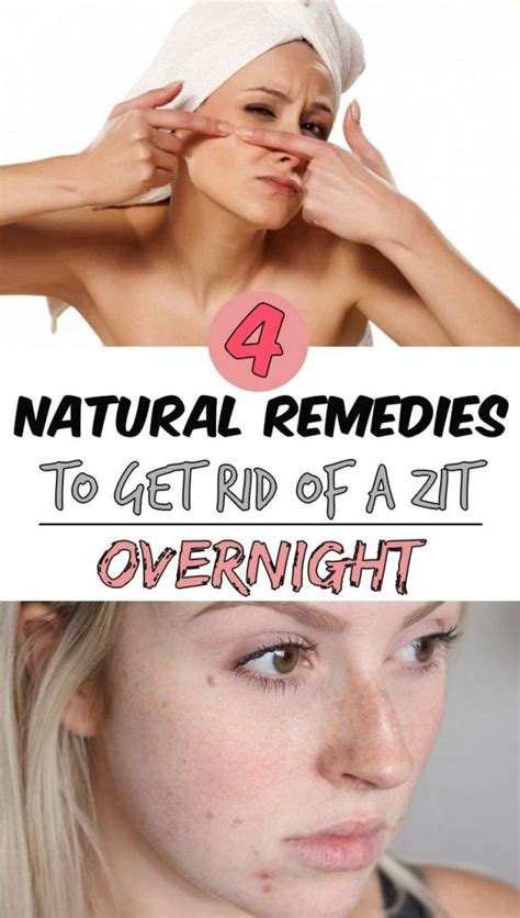 4 Natural Remedies To Get Rid Of A Zit Overnight Pimples Remedies