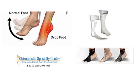 Foot Drop Treatment In Malaysia Without Surgery