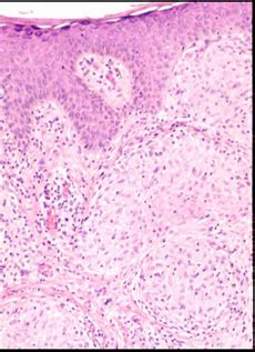 Image Of Sarcoidosis Pathology