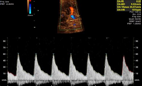 Acceptable Doppler Waveform From The Middle Cerebral Artery Note The