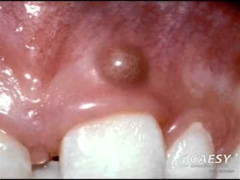 Find out what to do if you have an abscessed tooth. How to drain a gum abscess at home - Quora