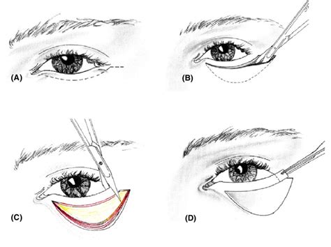 Schematic Drawing Of A Lateral Block Excision A Subciliary Incision