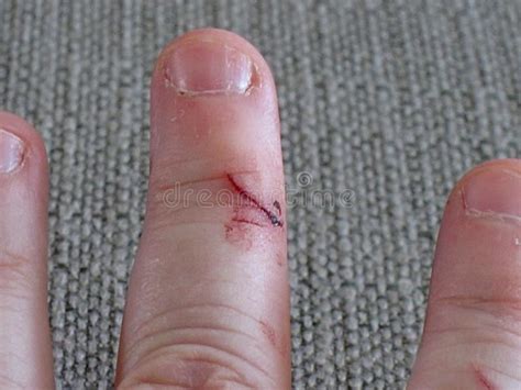 Cut Finger Wound Healthcare Related Stock Photo Image Of Fingernail