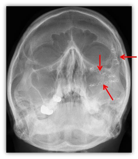 Neurosensory Assessment Of Infraorbital Nerve Injury Following