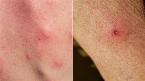 Is That A Mosquito Or Tick Bite How To Tell These Bug Bites Apart