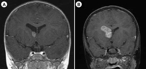 Subependymal Giant Cell Astrocytoma Mri Wikidoc