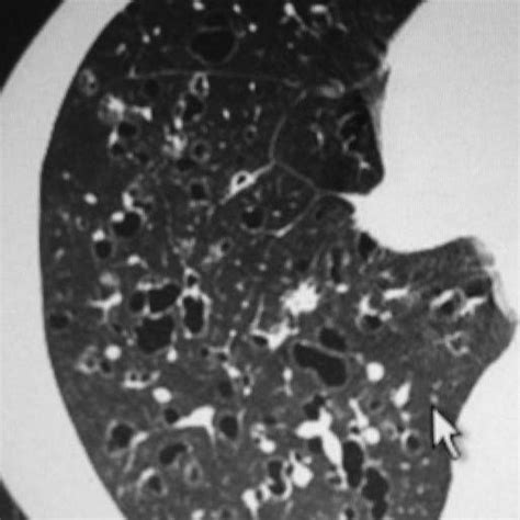 Subpleural Intralobular Interstitial Thickening Reticulation And