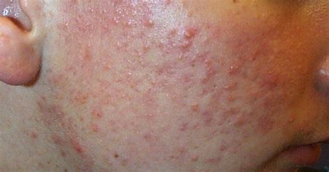 Acnepimples Acne Better Known As Pimples Is A Common Skin