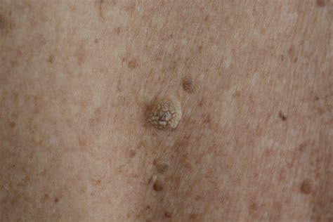 Liquid Nitrogen Skin Tags Information Yamru