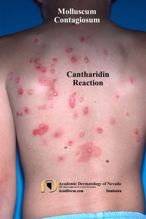 Molluscum Contagiosum Water Warts Academic Dermatology Of Nevada