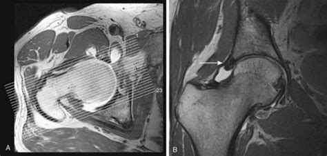 Magnetic Resonance Imaging Of The Hip Joint Musculoskeletal Key