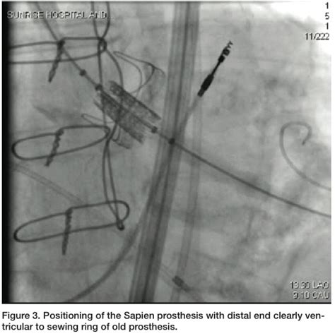 An Interesting Transcatheter Aortic Valve Replacement Tavr Case A