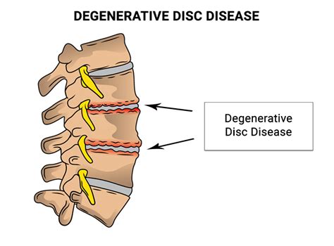 Cervical Degenerative Disc Disease Doctors Nj And Nyc
