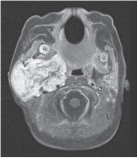 Rapidly Enlarging Neck Mass In An Infant Department Of Radiology