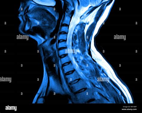 Ct Of The Cervical Spine Hi Res Stock Photography And Images Alamy
