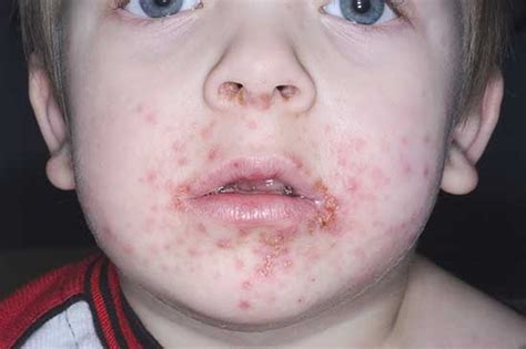 What Causes Blisters On Toddlers Lips