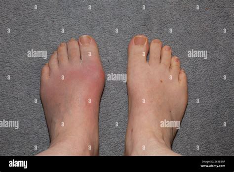 Gouty Toe A Most Painful Affliction Stock Photo Alamy