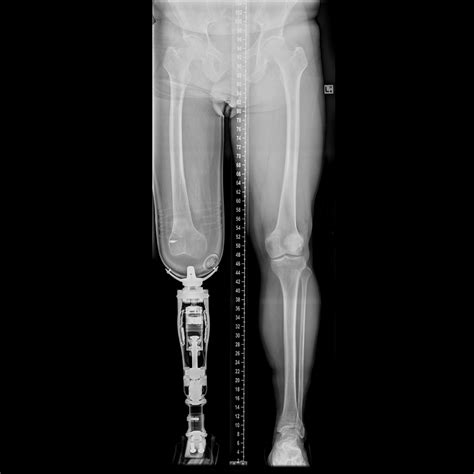 Transarticular Knee Amputation With Prosthetic Leg Image