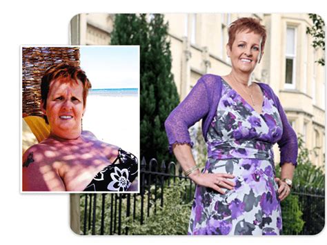 Gastric Band Success Stories Healthier Weight