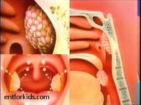 Tonsillectomy Adenoidectomy T A Surgery Youtube