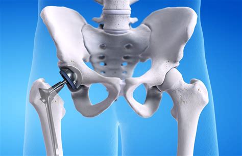 Types Of Hip Replacements Hosmat Hospital