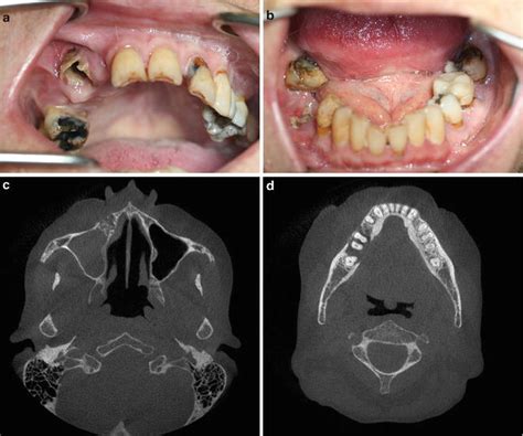 Management Of Osteonecrosis Of The Jaw In Patients Receiving