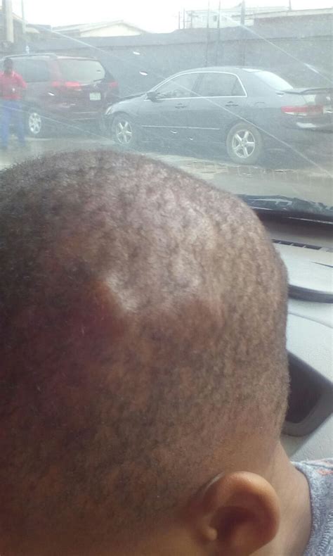 Multiple Bumps On My 3 Year Old Boy Scalp 2021 Jamb And Post Utme