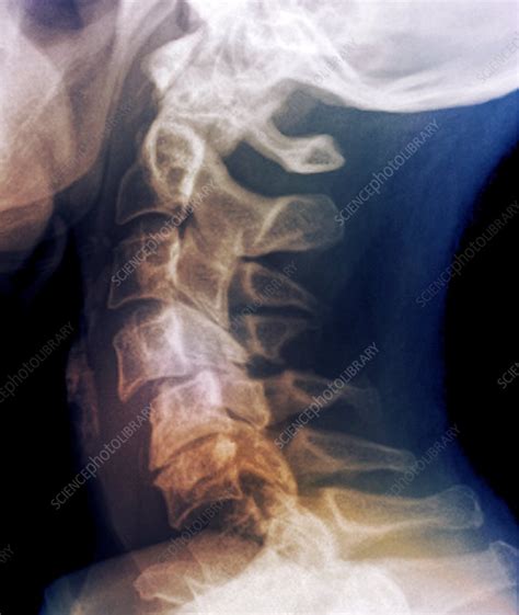 Dislocated Neck Bones X Ray Stock Image C0095457 Science Photo