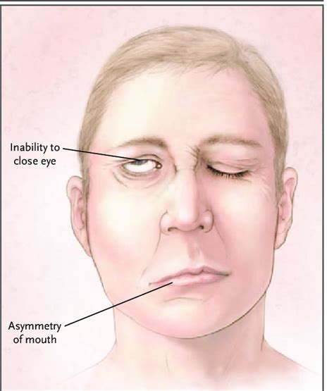 What Is Bell S Palsy Bells Palsy Facial Nerve Medical
