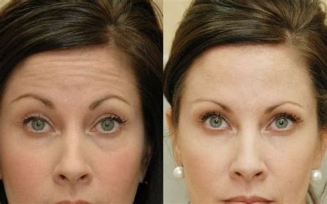 Segundo, según mi experiencia, el cabello que ya viene arruinado por eso es imposible decir cuanto tiempo van a durar los efectos del botox. Efecto Botox | Cuánto tiempo dura el efecto del Botox en ...